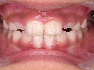 混合歯列期(phase1)の矯正: 埼玉・大宮の歯医者・矯正歯科なら「すずき