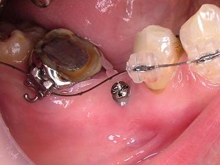 2010_1112ミニインプラント0004.JPG