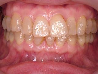 2010_1130whitening0003.JPG