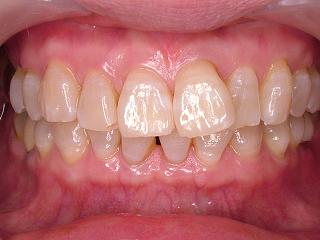 2010_1130whitening0009.JPG
