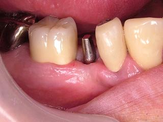 2011_0430implant0002.JPG