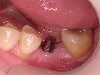 2011_0822インプラント0001.JPG