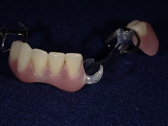 透明なバネの入れ歯