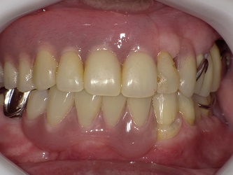 透明なバネの入れ歯