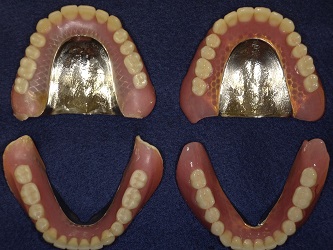 金属床義歯