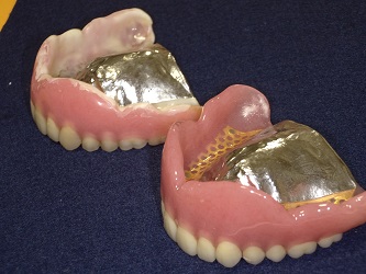 金属床義歯